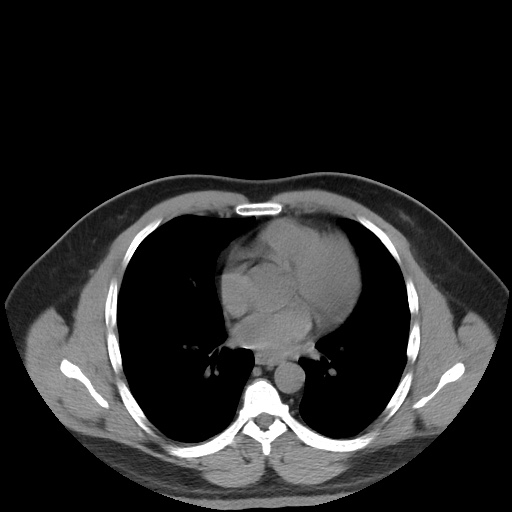 Autosomal dominant polycystic kidney disease (Radiopaedia 50259-55612 Axial non-contrast 4).jpg