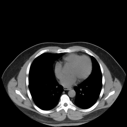 Autosomal dominant polycystic kidney disease (Radiopaedia 50259-55612 Axial non-contrast 6).jpg