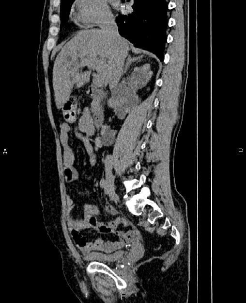 Autosomal dominant polycystic kidney disease (Radiopaedia 87830-104287 C 36).jpg