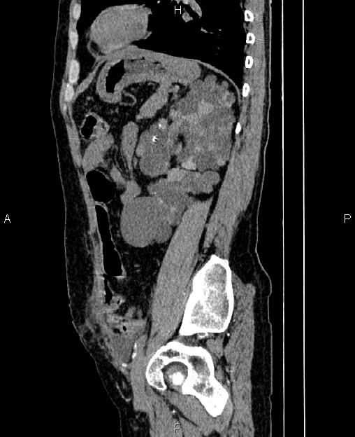 Autosomal dominant polycystic kidney disease (Radiopaedia 87830-104287 C 65).jpg