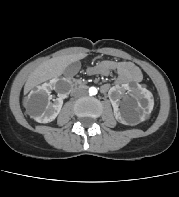 Autosomal dominant polycystic kidney disease - early onset (Radiopaedia 40734-43387 B 35).jpg