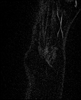 Avascular necrosis of the capitate (Radiopaedia 88317-104948 Coronal T1 vibe 3).jpg