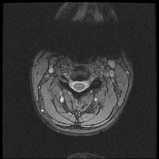 File:Axis fracture - MRI (Radiopaedia 71925-82375 Axial T2 fat sat 8).jpg