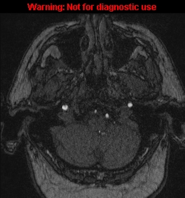 Azygos anterior cerebral artery (Radiopaedia 59325-66677 Axial MRA 15).jpg