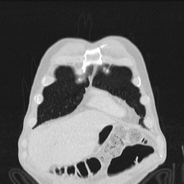 Azygos lobe (Radiopaedia 38259-40275 Coronal lung window 12).jpg