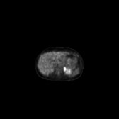 B-cell lymphoma of the mesentery (Radiopaedia 65743-74868 18F-FDG PET-CT 161).jpg