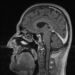 File:Balo concentric sclerosis (Radiopaedia 50458-55940 Sagittal T1 C+ 82).jpg