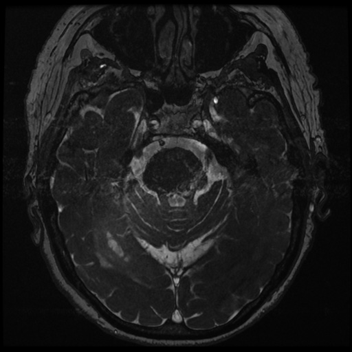 File:Balo concentric sclerosis (Radiopaedia 53875-59982 Axial T2 FIESTA 58).jpg
