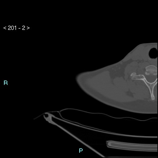 Bankart lesion with glenoid bone defect - assessment TC with PICO method (Radiopaedia 42855-93901 Axial bone window 1).jpg