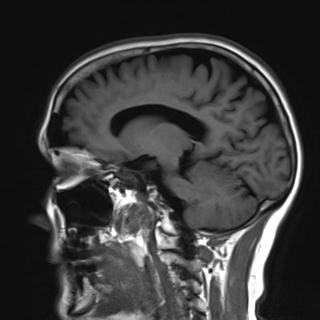 File:Base of skull chondrosarcoma (Radiopaedia 30410-31070 Sagittal T1 12).jpg