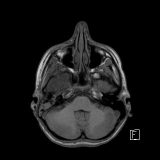 Base of skull rhabdomyosarcoma (Radiopaedia 32196-33142 Axial T1 11).jpg