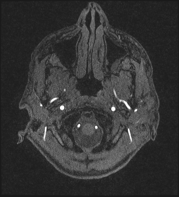 Basilar artery perforator aneurysm (Radiopaedia 82455-97733 Axial MRA 17).jpg