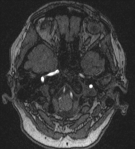 Basilar tip aneurysm (Radiopaedia 26504-26632 MRA 31).jpg