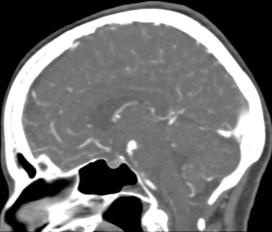 Basilar tip aneurysm with coiling (Radiopaedia 53912-60086 C 63).jpg