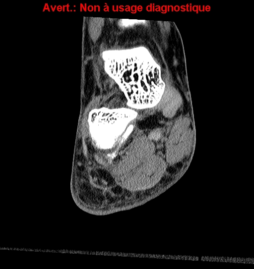 Baxter neuropathy (Radiopaedia 25988-26125 Coronal non-contrast 11).jpg