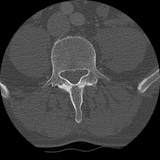 Benign post-traumatic pseudopneumoperitoneum (Radiopaedia 71199-81495 Axial bone window 256).jpg