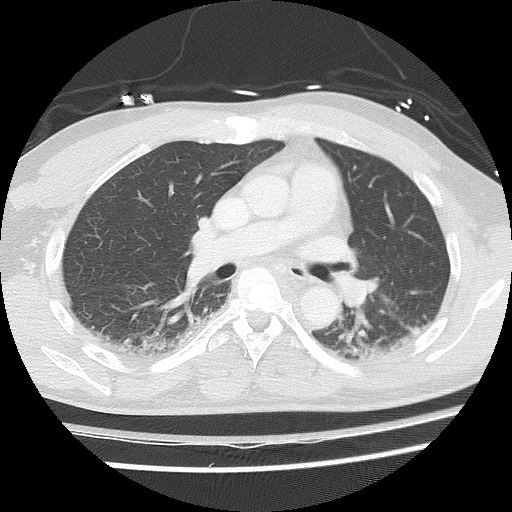 Benign post-traumatic pseudopneumoperitoneum (Radiopaedia 71199-81495 Axial lung window 36).jpg