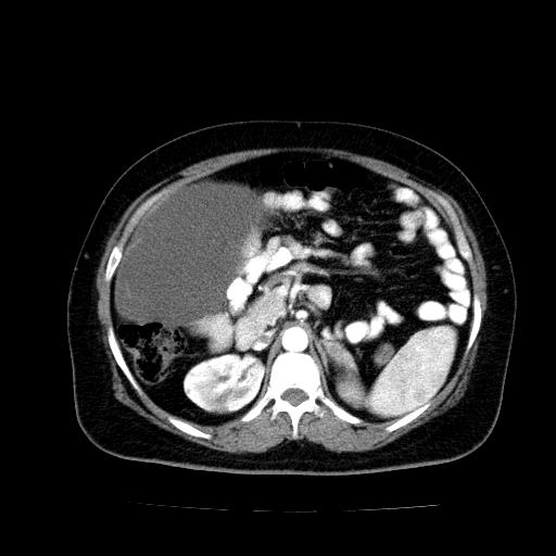 Benign spindle cell tumor - abdominopelvic (Radiopaedia 61300-69212 A 21).jpg