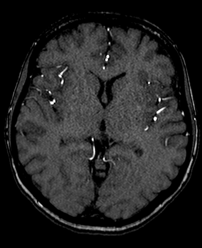 Berry aneurysm of the terminal internal carotid artery (Radiopaedia 88286-104918 Axial TOF 125).jpg