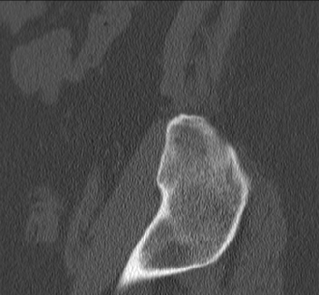 Bertolotti syndrome (Radiopaedia 24864-25128 Sagittal bone window 57).jpg