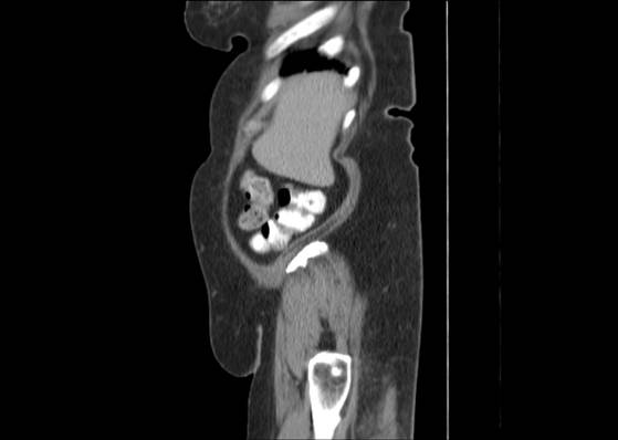 Bicameral celiacomesenteric aneurysm (Radiopaedia 55766-62327 B 8).jpg