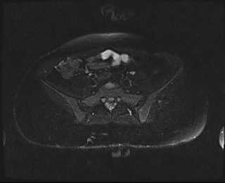 File:Bicornuate bicollis uterus (Radiopaedia 61626-69616 Axial PD fat sat 4).jpg