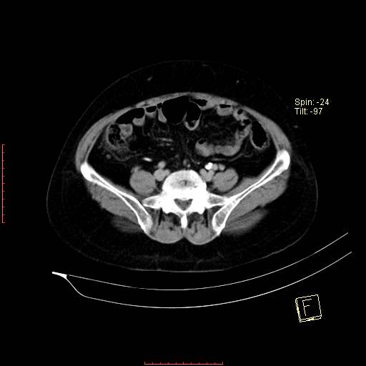 File:Bifid ureter (Radiopaedia 47604-52253 Axial C+ delayed 18).jpg