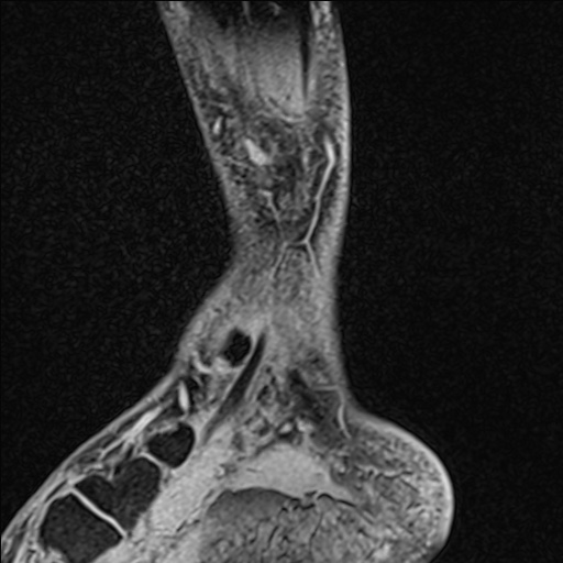 Bilateral Achilles tendon complete tear (Radiopaedia 81344-95051 Sagittal WE - Left 28).jpg