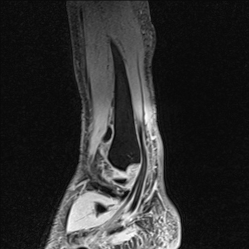 Bilateral Achilles tendon complete tear (Radiopaedia 81344-95051 Sagittal WE - Left 92).jpg