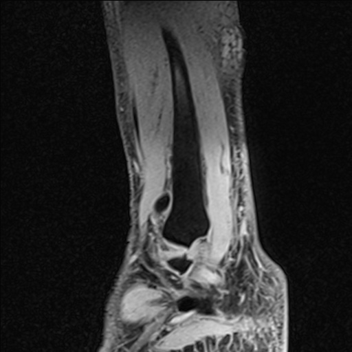 Bilateral Achilles tendon complete tear (Radiopaedia 81344-95051 Sagittal WE - Right 27).jpg