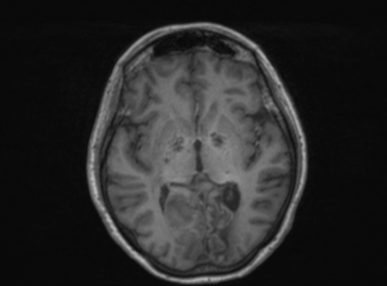 Bilateral PCA territory infarction - different ages (Radiopaedia 46200-51784 Axial T1 241).jpg