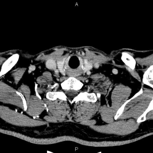 File:Bilateral Warthin tumors (Radiopaedia 84034-99263 Axial With contrast 55).jpg