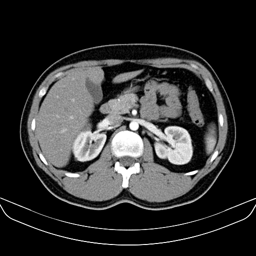 Bilateral accessory renal arteries with mild pelvi-ureteric junction (PUJ) obstruction (Radiopaedia 66357-75596 A 19).jpg