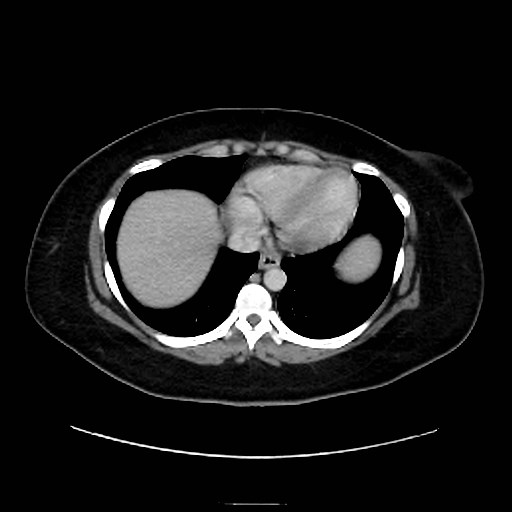 Bilateral adrenal thrombosis (Radiopaedia 58182-65256 A 3).jpg