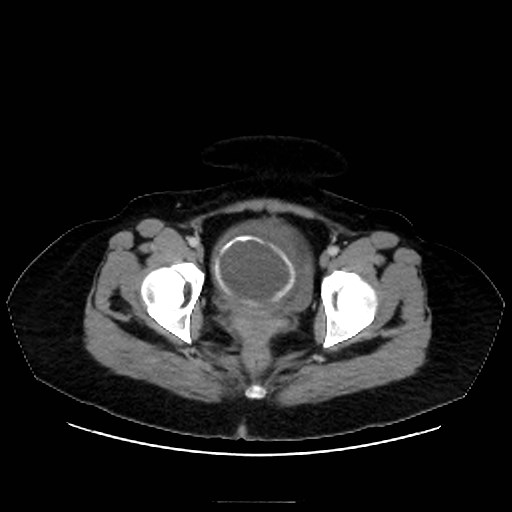 Bilateral adrenal thrombosis (Radiopaedia 58182-65256 A 73).jpg