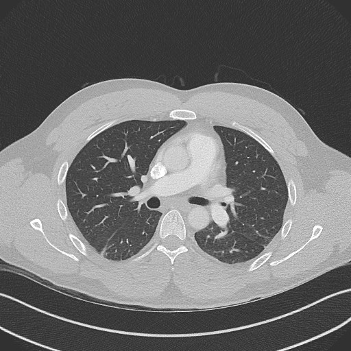 Bilateral atelectasis (Radiopaedia 48666-53675 Axial lung window 50).jpg