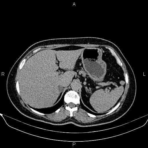 Bilateral benign adrenal adenomas (Radiopaedia 86912-103124 Axial C+ delayed 22).jpg