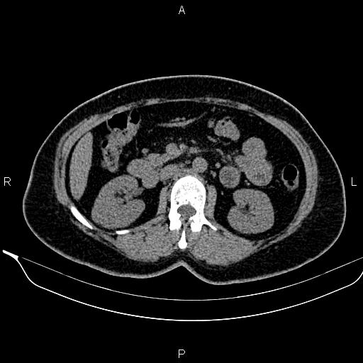 Bilateral benign adrenal adenomas (Radiopaedia 86912-103124 Axial non-contrast 51).jpg
