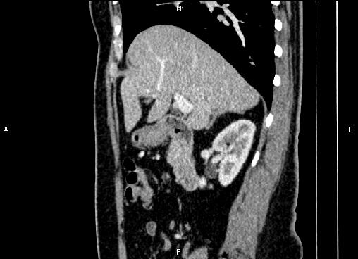 Bilateral benign adrenal adenomas (Radiopaedia 86912-103124 E 34).jpg
