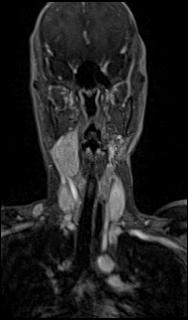 Bilateral carotid body tumors and right glomus jugulare tumor (Radiopaedia 20024-20060 MRA 20).jpg