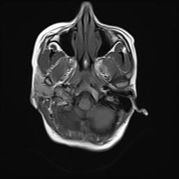 File:Bilateral carotid body tumors and right jugular paraganglioma (Radiopaedia 20024-20060 Axial 21).jpg