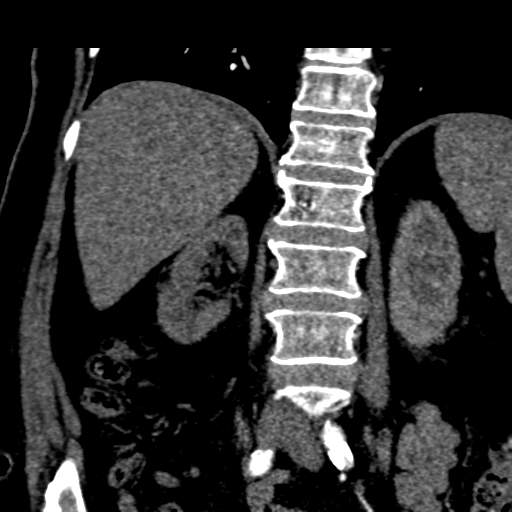 File:Bilateral delayed nephrogram from renal artery stenosis (Radiopaedia 47681-52362 C 11).png