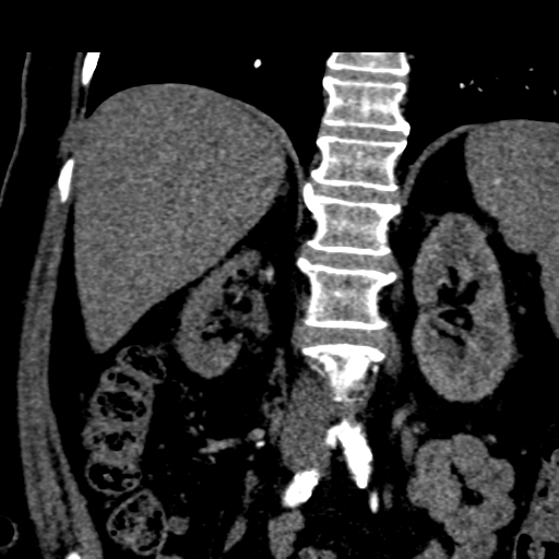 File:Bilateral delayed nephrogram from renal artery stenosis (Radiopaedia 47681-52362 C 9).png