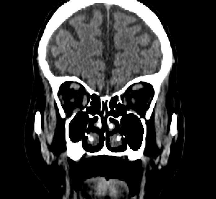 Bilateral ectopia lentis (Radiopaedia 89889-107013 Coronal non-contrast 69).jpg