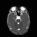 File:Bilateral mesial temporal polymicrogyria (Radiopaedia 76456-88181 Axial ADC 8).jpg