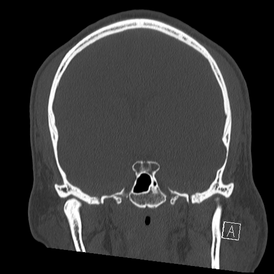 Bilateral occipital condyle fracture (type 2) (Radiopaedia 87675-104089 Coronal bone window 57).jpg