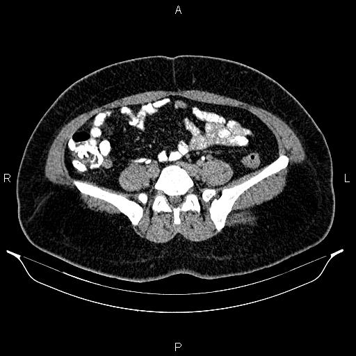 Bilateral ovarian dermoid cysts (Radiopaedia 85785-101603 Axial C+ delayed 53).jpg
