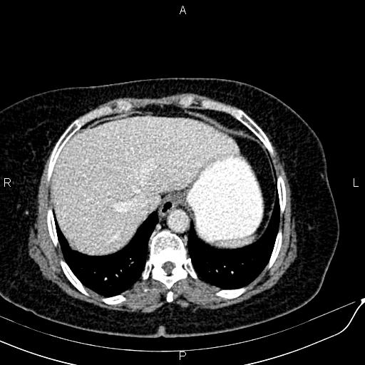 Bilateral ovarian serous cystadenocarcinoma (Radiopaedia 86062-101989 B 16).jpg