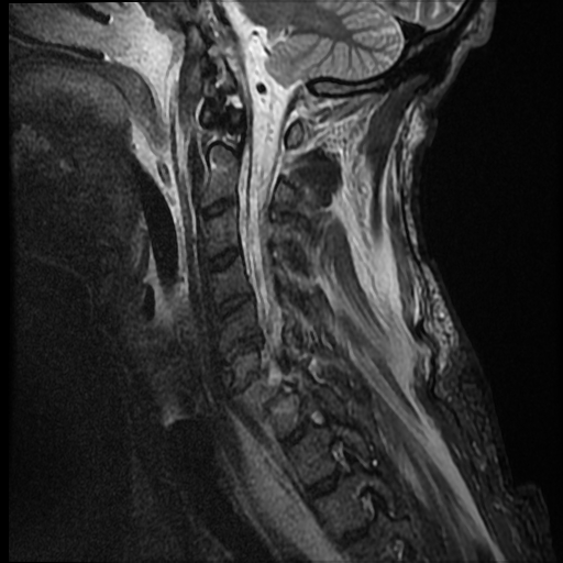 File:Bilateral perched facets with cord injury (Radiopaedia 45587-49714 Sagittal STIR 11).jpg