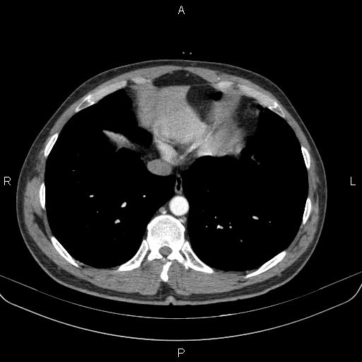 Bilateral pulmonary AVM (Radiopaedia 83134-97505 A 56).jpg